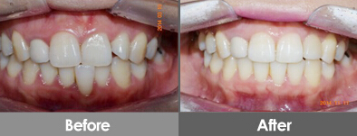 韩国牙齿整形对比案例